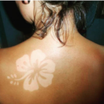 Haut du dos d'une femme avec un "sunburn art" ou coup de soleil artistique, représentant une fleur.
