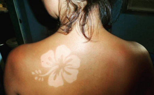 Haut du dos d'une femme avec un "sunburn art" ou coup de soleil artistique, représentant une fleur.