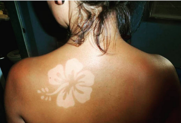 Haut du dos d'une femme avec un "sunburn art" ou coup de soleil artistique, représentant une fleur.
